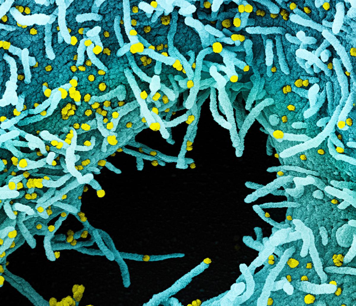 Colorized image of yellow COVID-19 causing viruses attached to cells